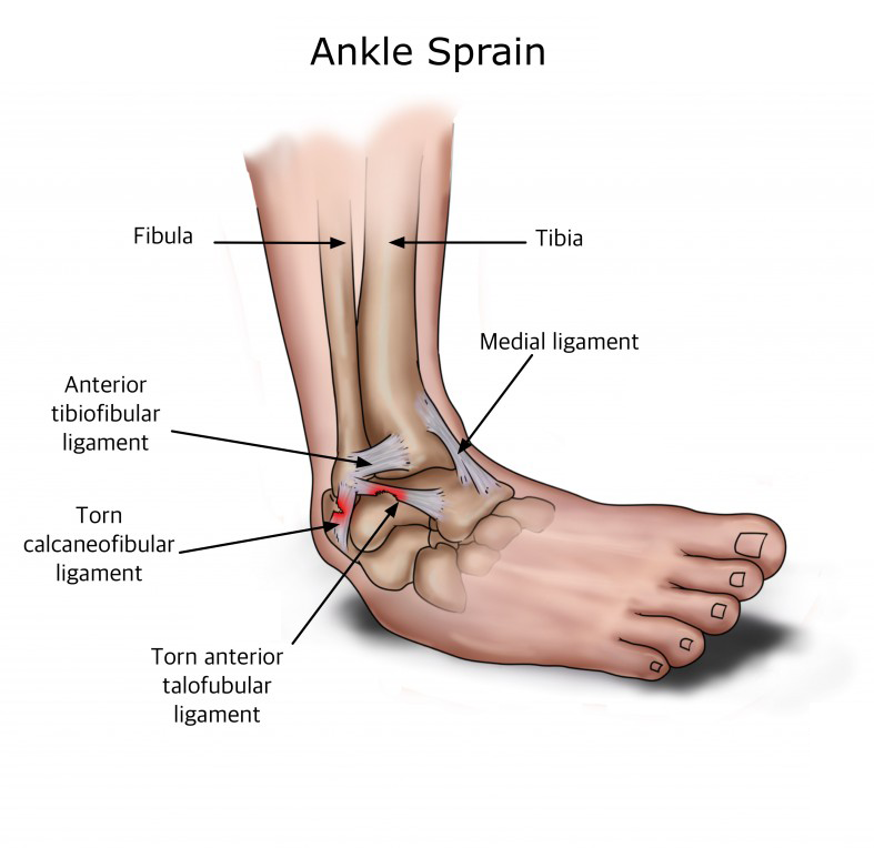 Ankle Sprain Internals